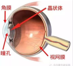 眼科專家趙娟：家長(zhǎng)如何自查孩子有沒(méi)有先天性白內(nèi)障