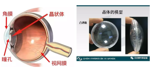 眼科專家趙娟：家長(zhǎng)如何自查孩子有沒(méi)有先天性白內(nèi)障