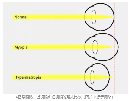 探討青少年近視與電子屏幕關系，近視關聯強因素詳細分析